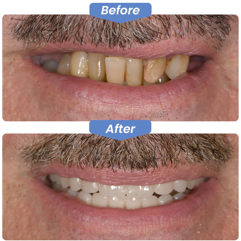 Before-After-Smile-Gallery-2
