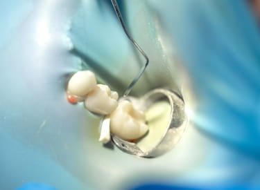 Dental Fillings Stillwater, MN