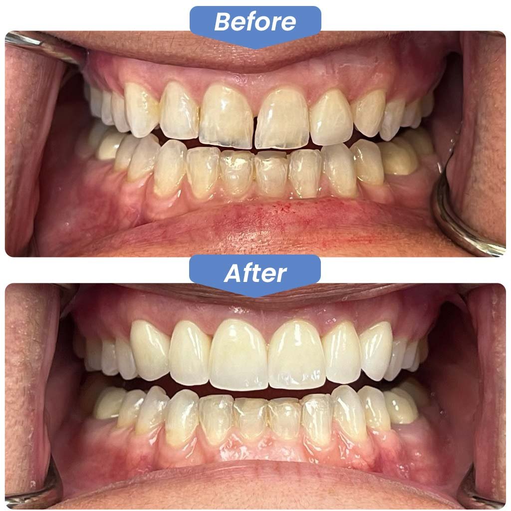 Front-Teeth-Crown-Before-After