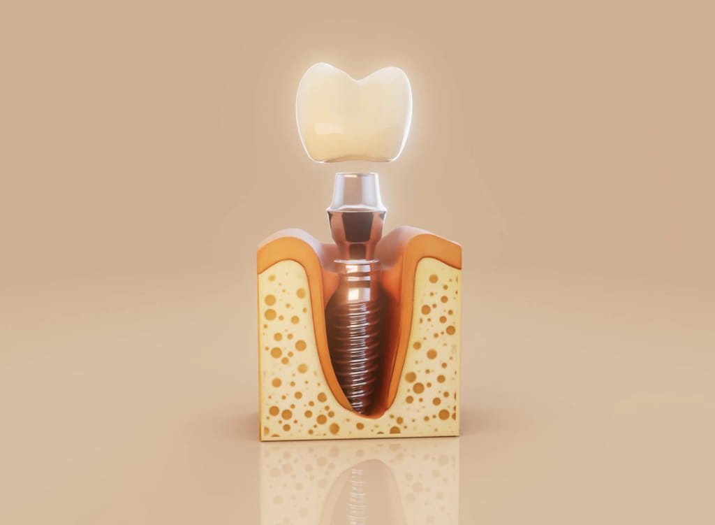 Dental Implants in Stillwater, MN