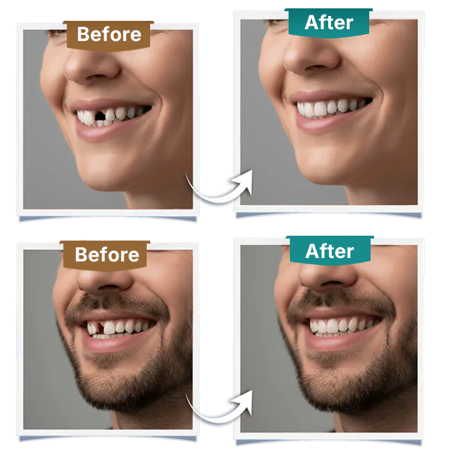Implant dentiistry - Before After